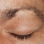 Alopecia Areata A Reason Your Eyelashes Fall Out